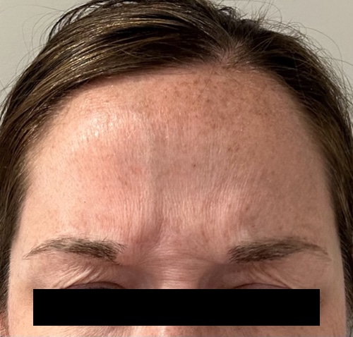 Before Image: Botox - front