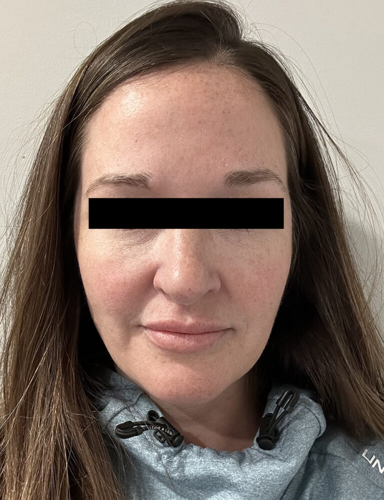 After Image: ADVATx - front