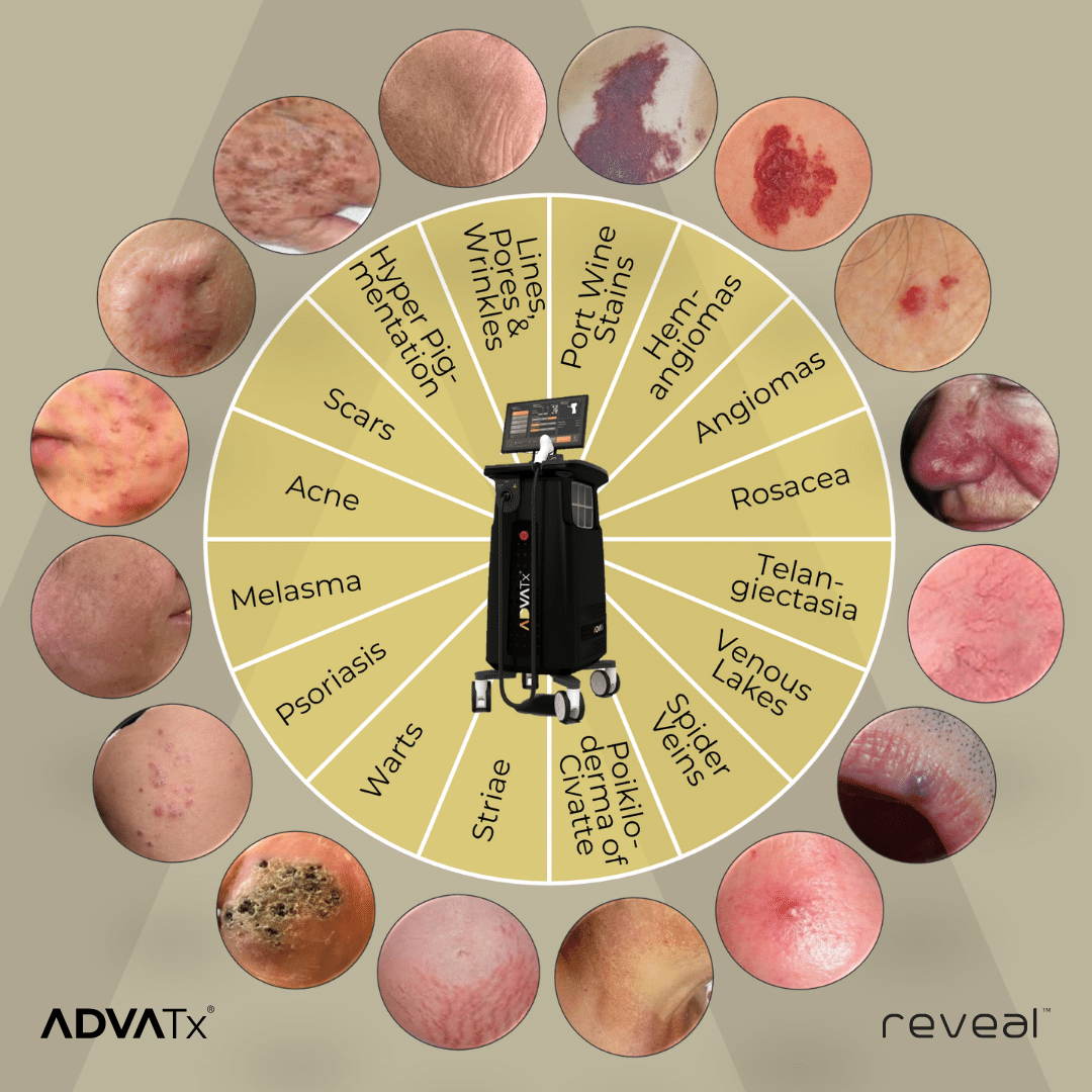 Adva 20 FDA CA Wheel 2