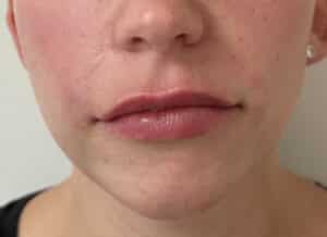After Image: Lip & Lower Face Fillers