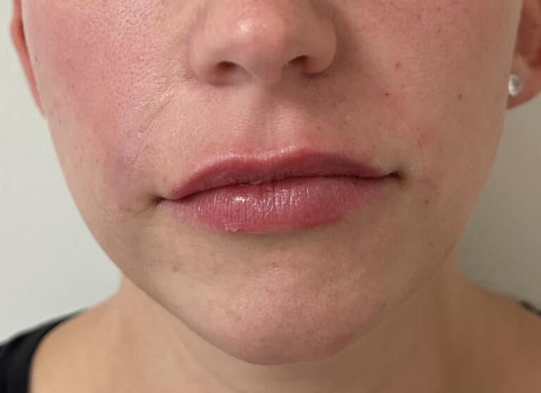 After Image: Lip & Lower Face Fillers - front