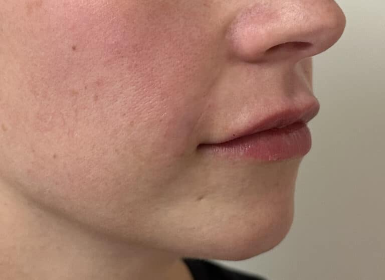 After Image: Lip & Lower Face Fillers - right-front-oblique