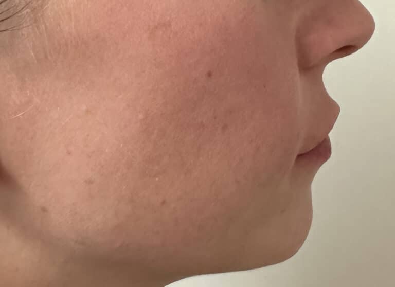 After Image: Lip & Lower Face Fillers - right-side