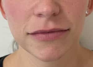 Before Image: Lip & Lower Face Fillers
