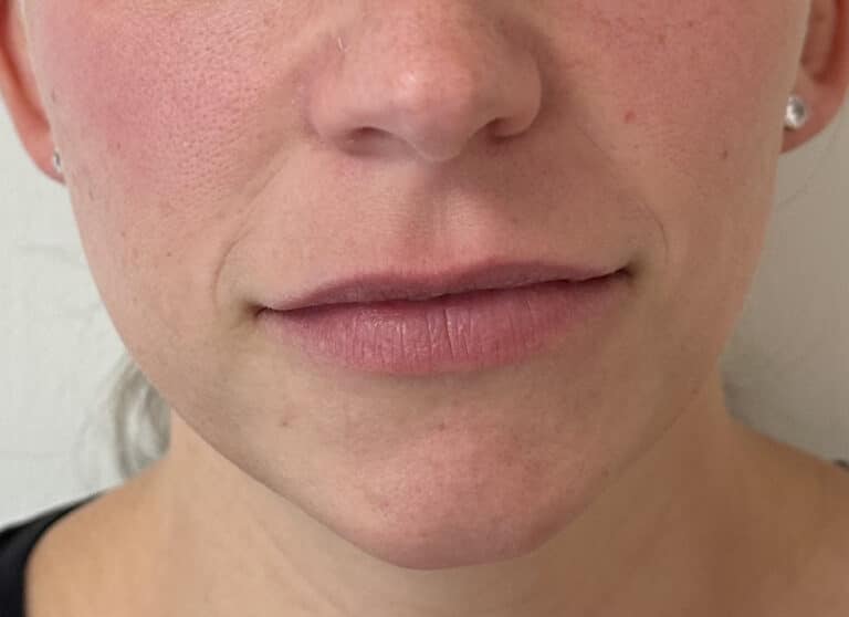 Before Image: Lip & Lower Face Fillers - front