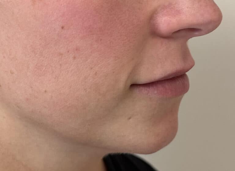 Before Image: Lip & Lower Face Fillers - right-front-oblique