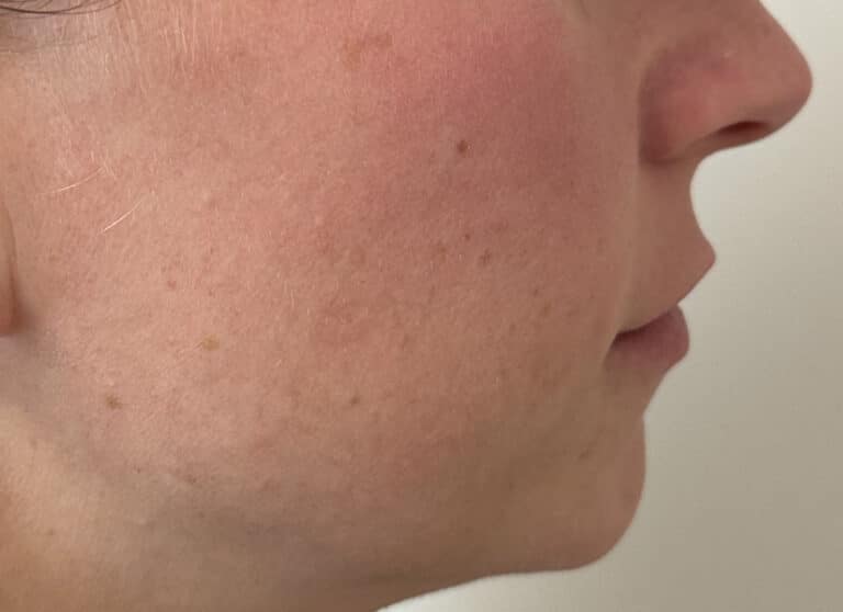Before Image: Lip & Lower Face Fillers - right-side