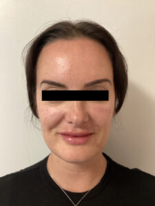 After Image: Cheek Filler