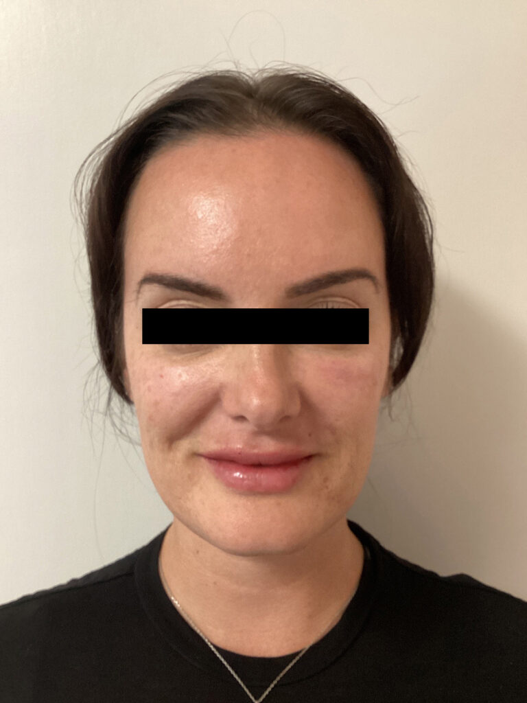 After Image: Cheek Filler - front