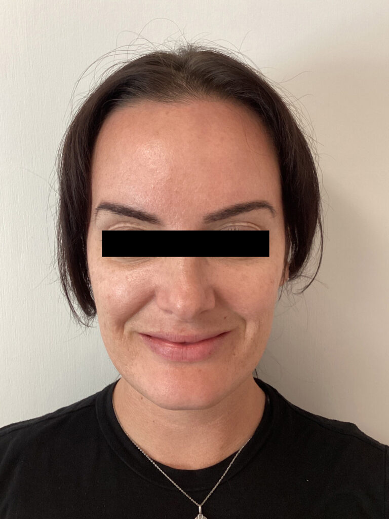 Before Image: Cheek Filler - front