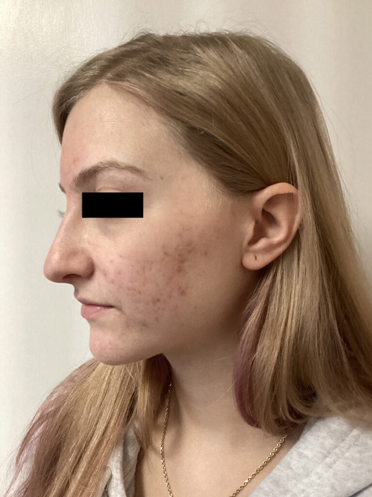 After Image: ADVATx - left-front-oblique
