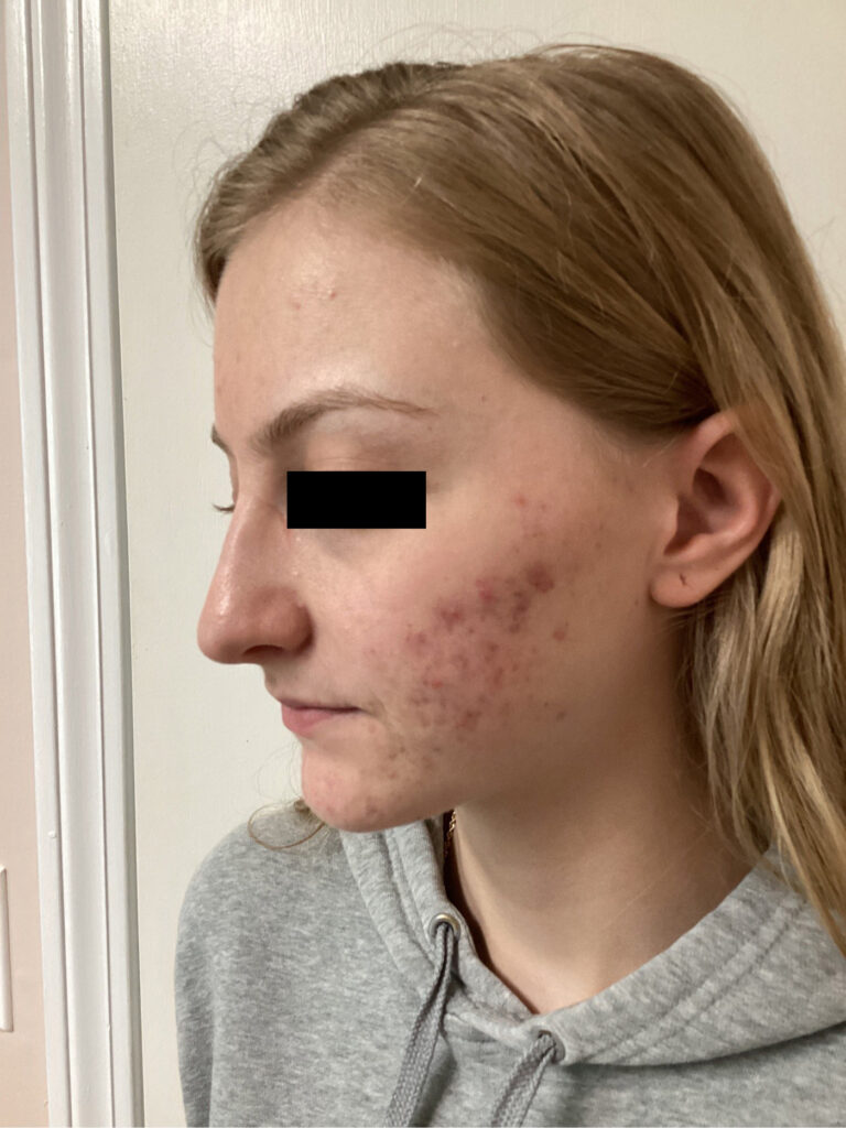 Before Image: ADVATx - left-front-oblique