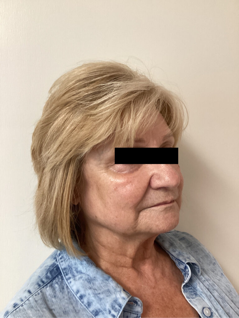 Before Image: Sculptra - right-front-oblique