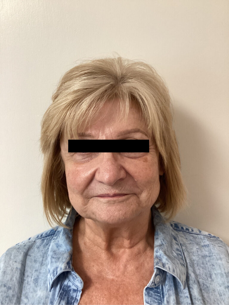 Before Image: Sculptra - front