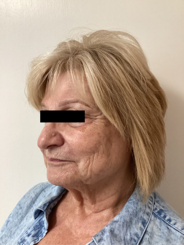 Before Image: Sculptra - front