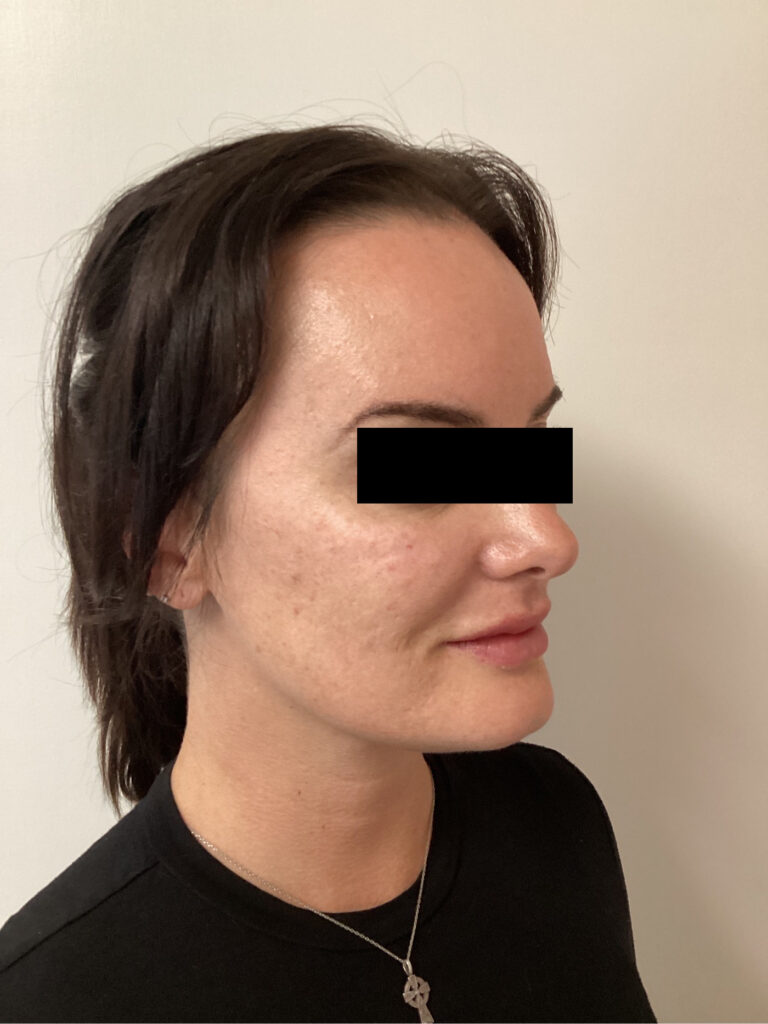 After Image: Cheek Filler - right-front-oblique