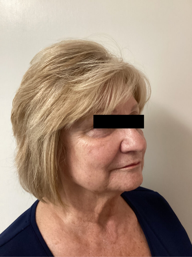 After Image: Sculptra - right-front-oblique