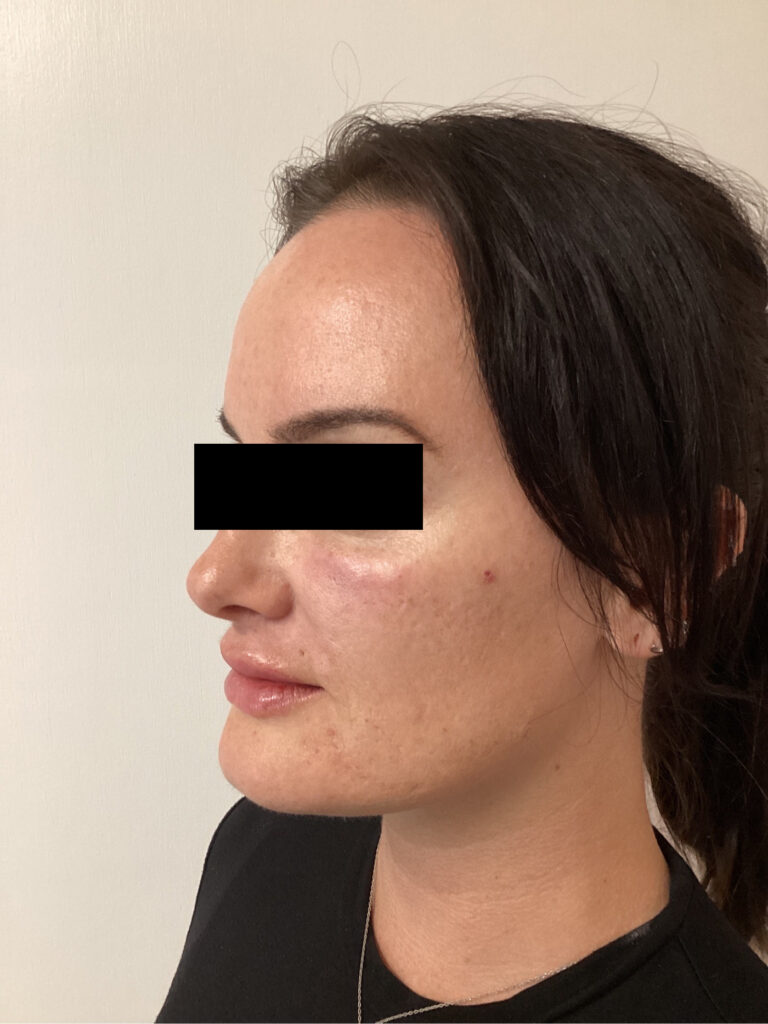 After Image: Cheek Filler - left-front-oblique
