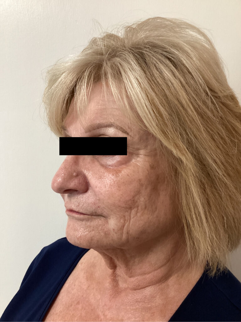 After Image: Sculptra - front