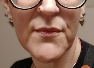 After Image: Lip Filler