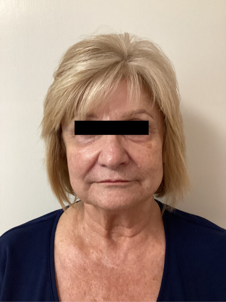 After Image: Sculptra - front
