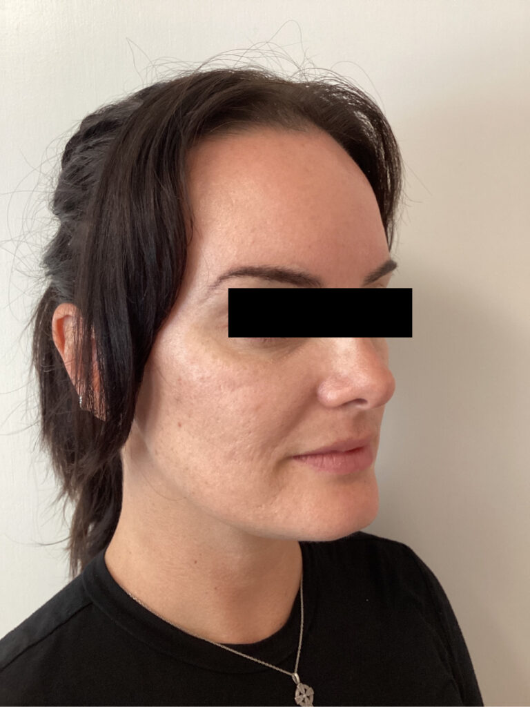 Before Image: Cheek Filler - right-front-oblique