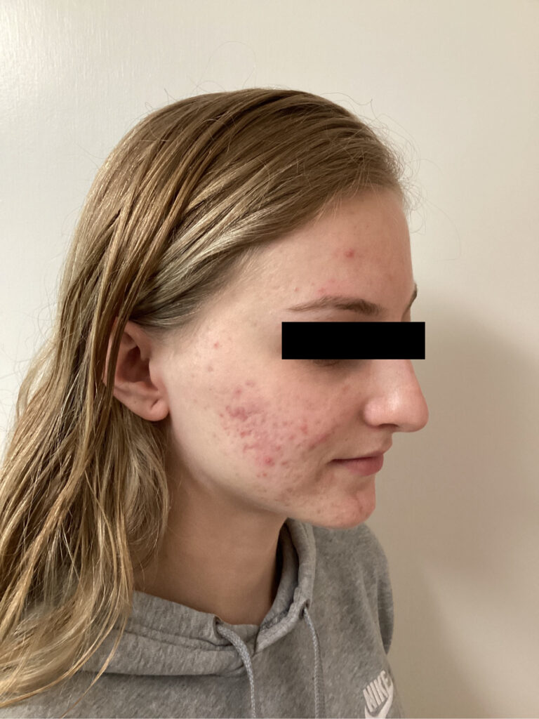 Before Image: ADVATx - right-front-oblique