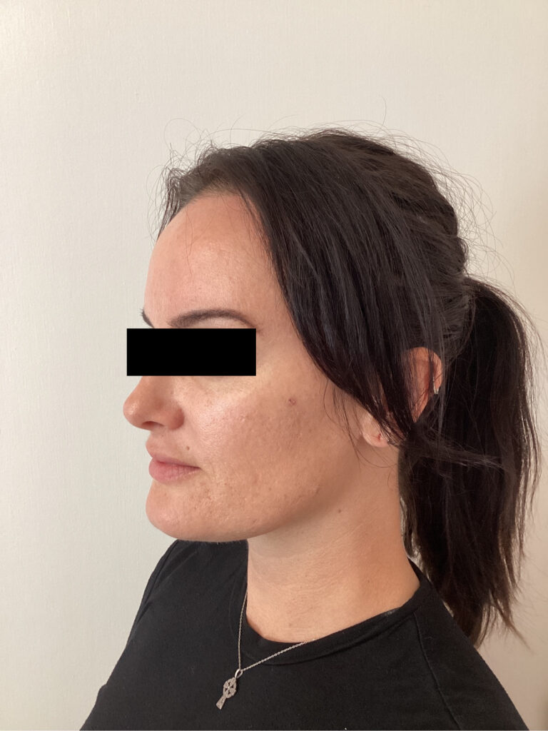 Before Image: Cheek Filler - left-front-oblique