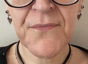 Before Image: Lip Filler