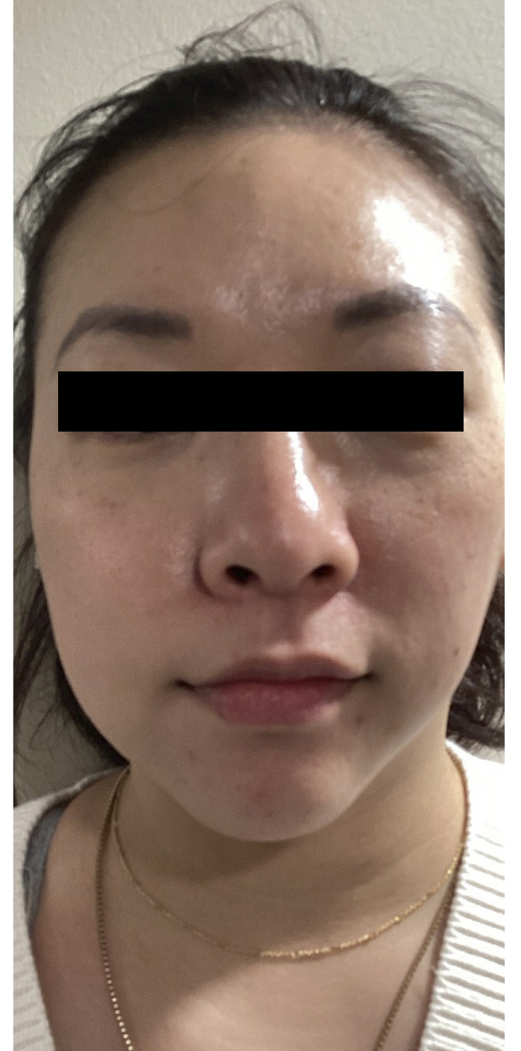 Before Image: Sculptra - front