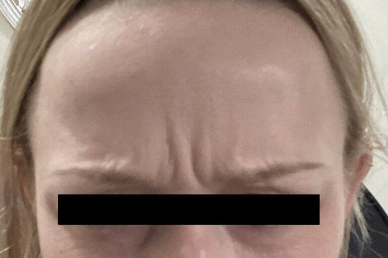 Before Image: Botox - front