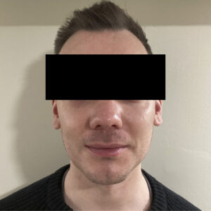 After Image: Chin and Jawline Filler