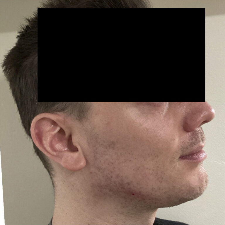 After Image: Chin and Jawline Filler - right-front-oblique