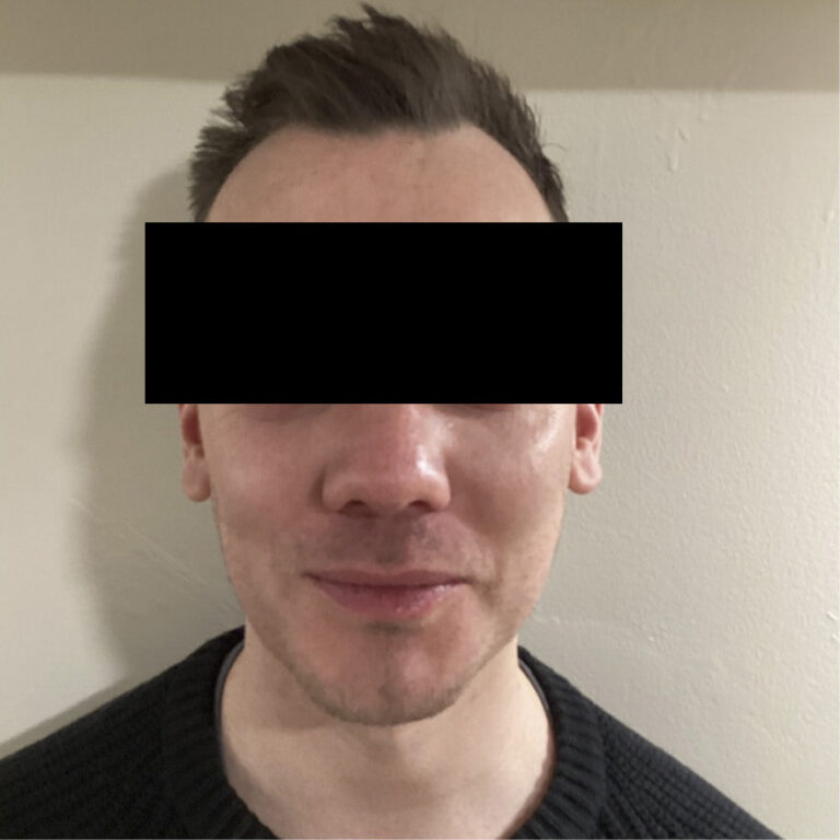 Before Image: Chin and Jawline Filler - front