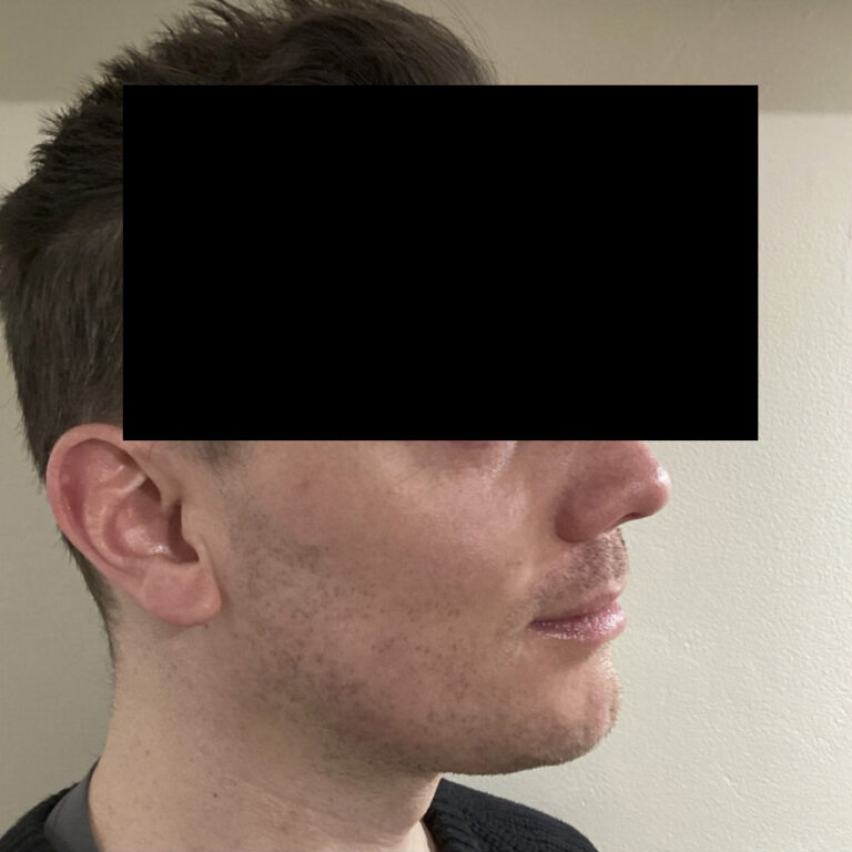 Before Image: Chin and Jawline Filler - right-front-oblique