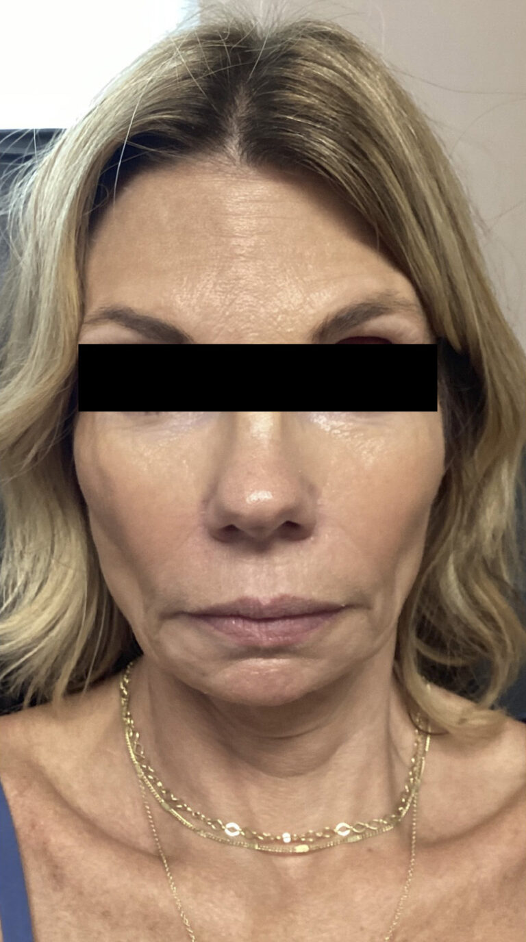 After Image: Sculptra - front