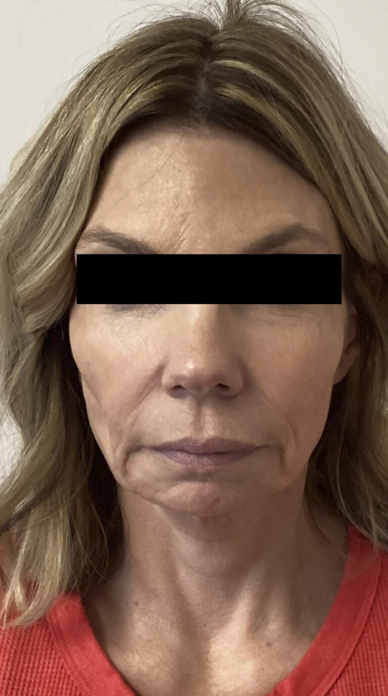 Before Image: Sculptra - front