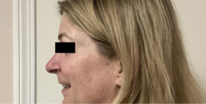 After Image: Sculptra