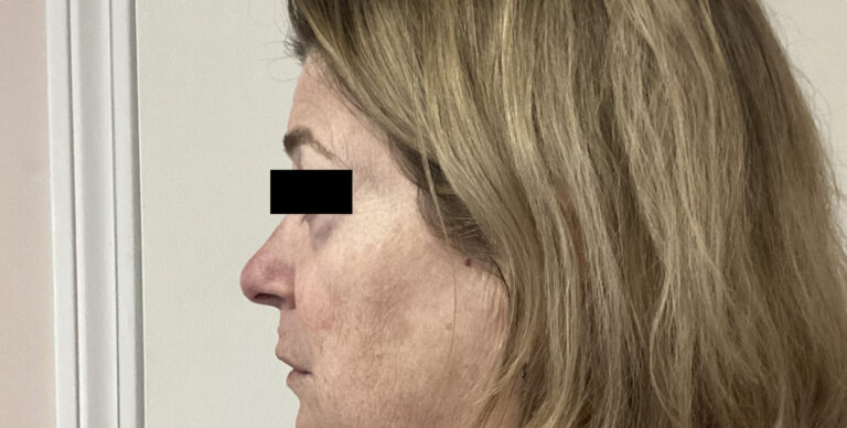 Before Image: Sculptra - left-side