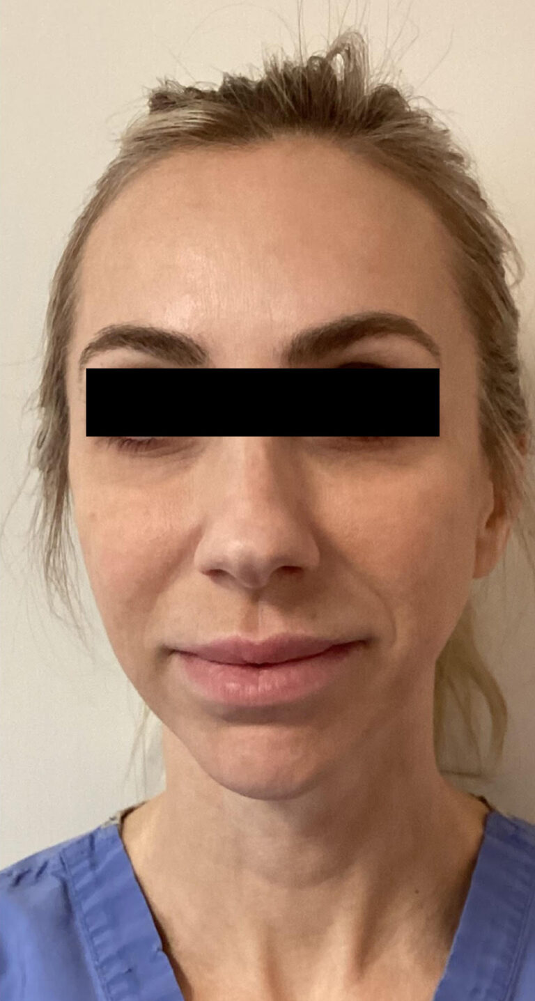 After Image: Sculptra - front