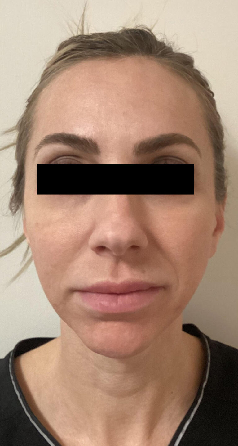 Before Image: Sculptra - front