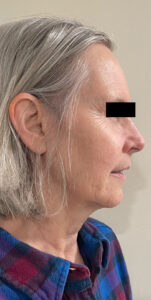 After Image: Sculptra