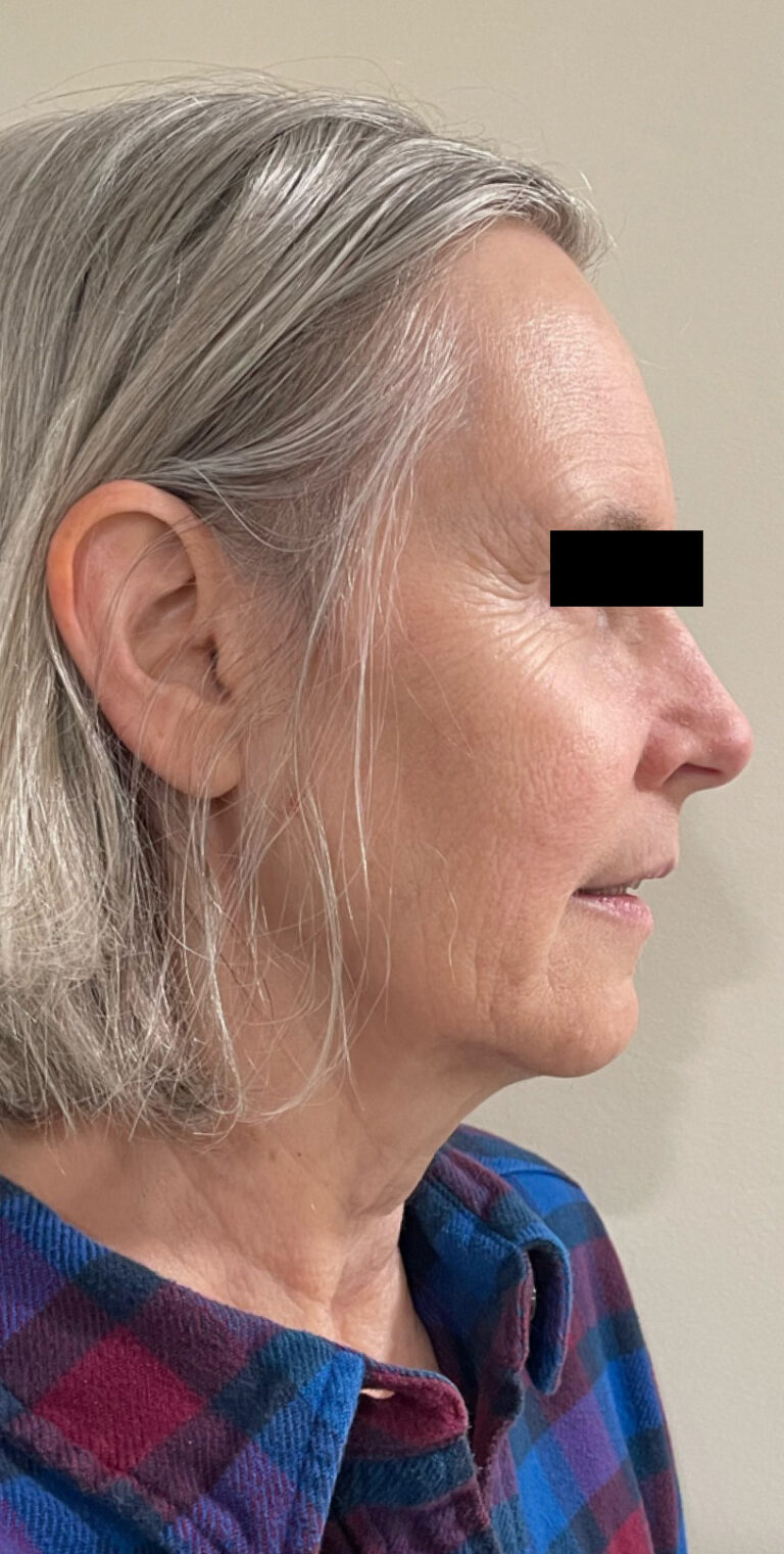 After Image: Sculptra - right-side