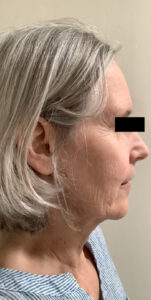 Before Image: Sculptra