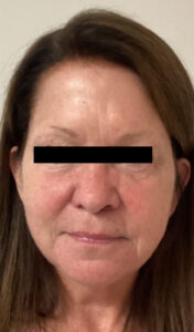 After Image: Sculptra