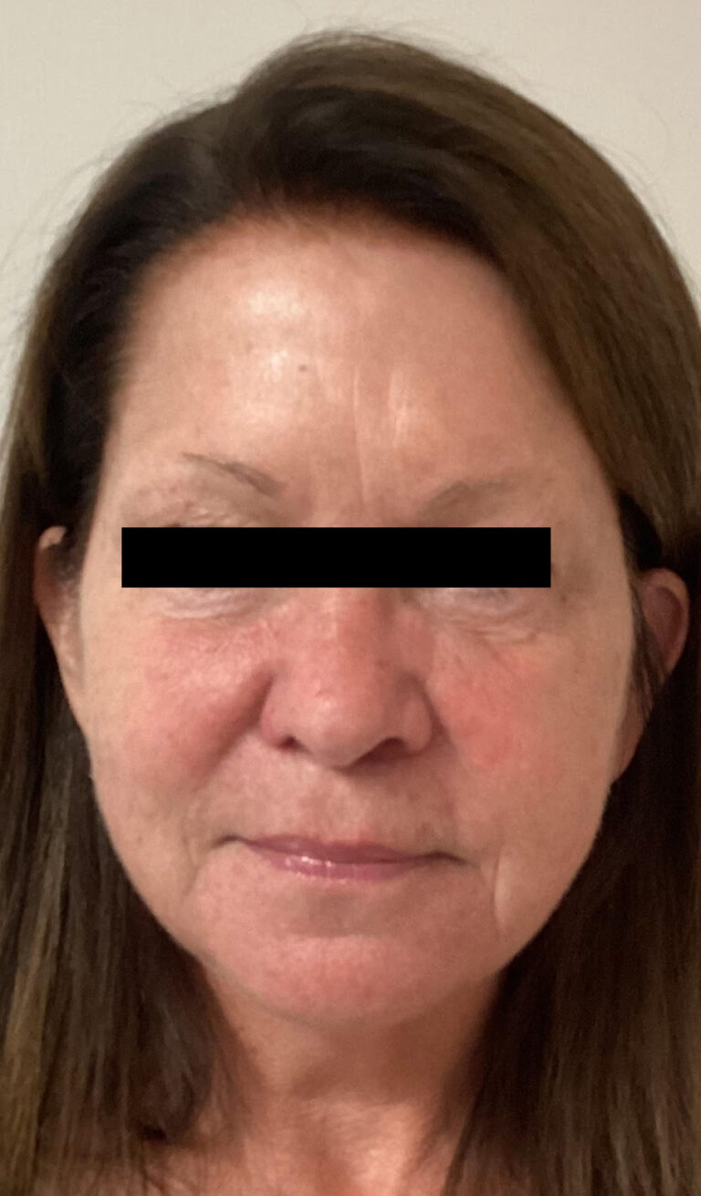 After Image: Sculptra - front