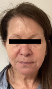 Before Image: Sculptra