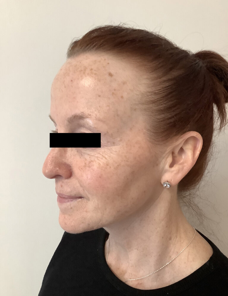 Before Image: ADVATx - left-front-oblique